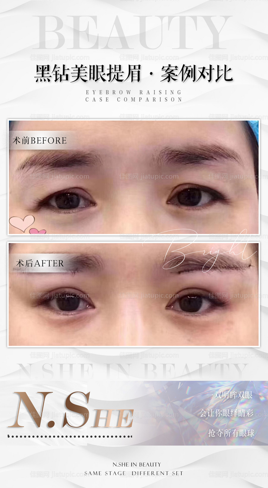 医美案例图-源文件