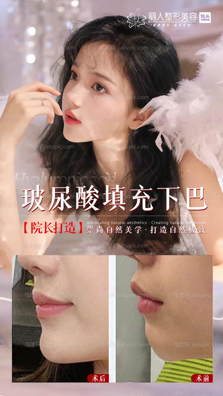 玻尿酸填充下巴案例海报-源文件