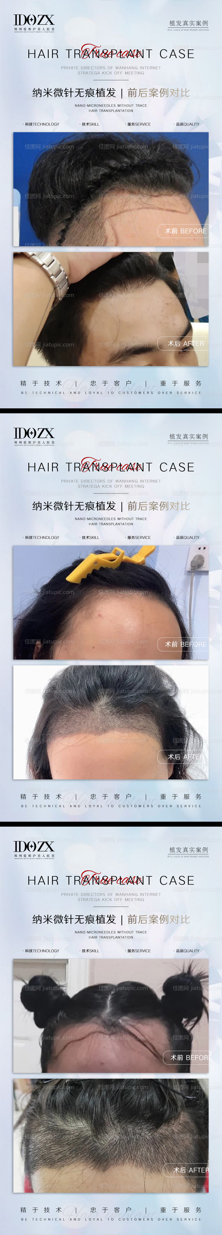 医美整形案例对比海报-源文件