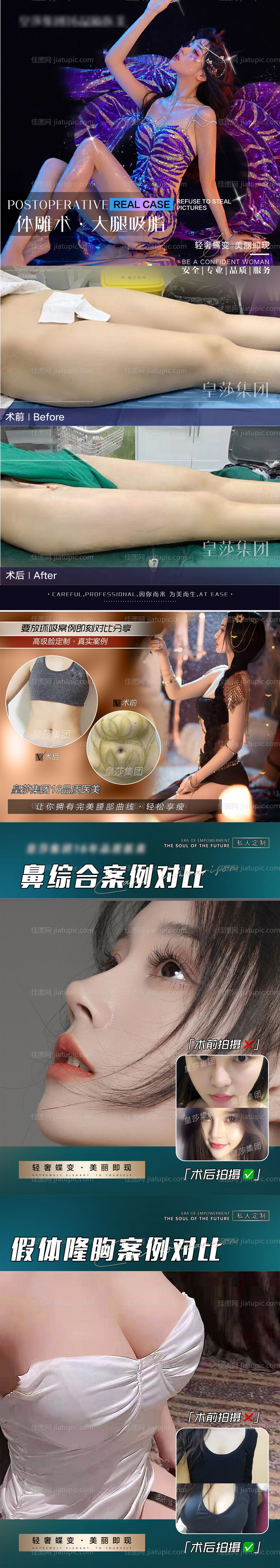 医美案例大腿环吸海报-源文件