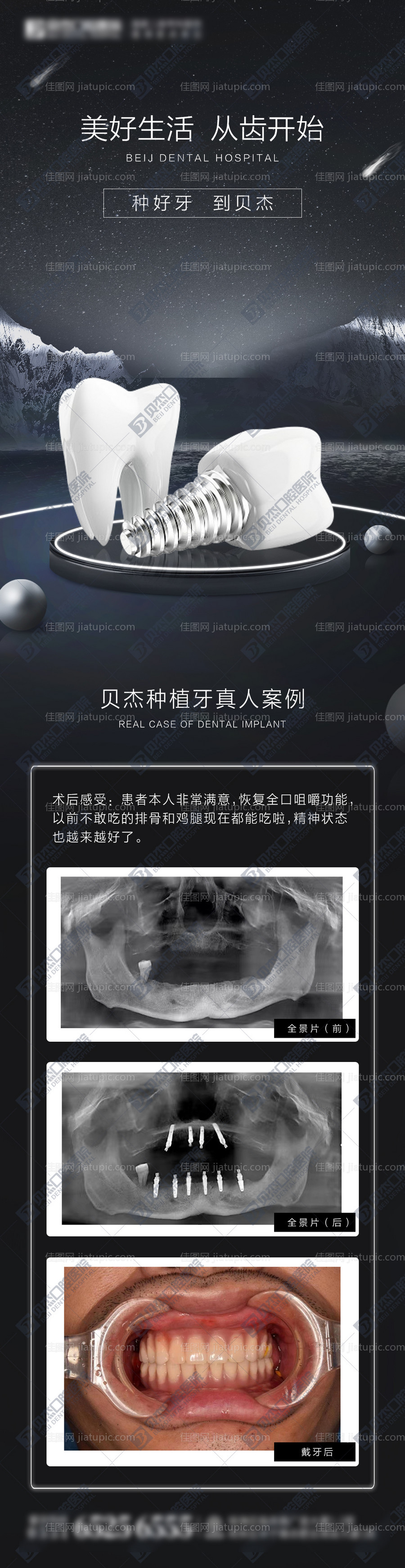 种植牙案例-源文件