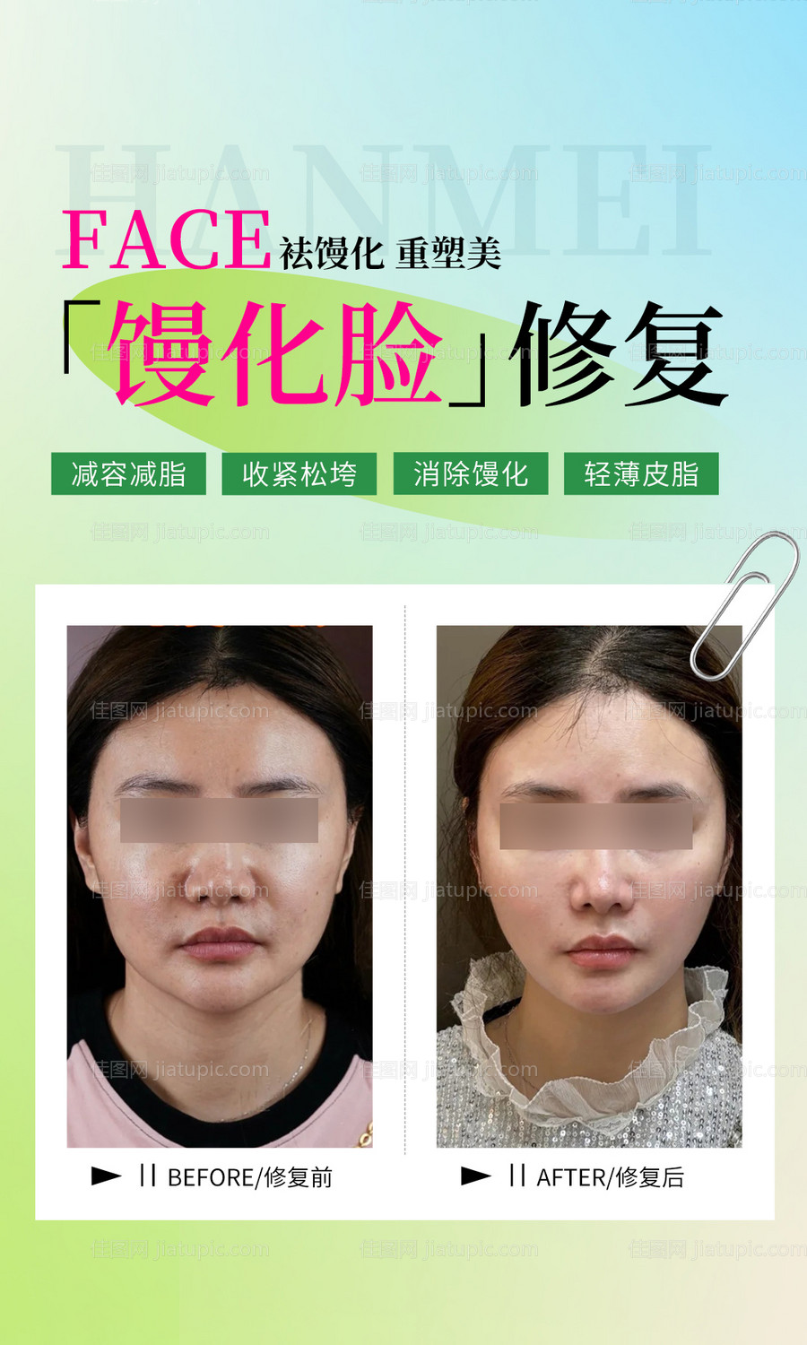 医美馒化脸修复案例海报-源文件