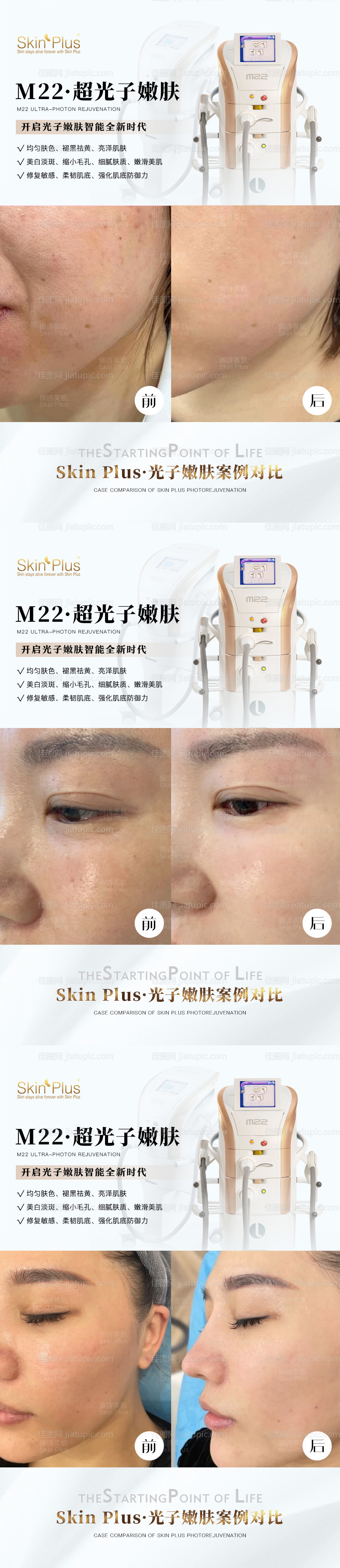 医美光子嫩肤海报-源文件