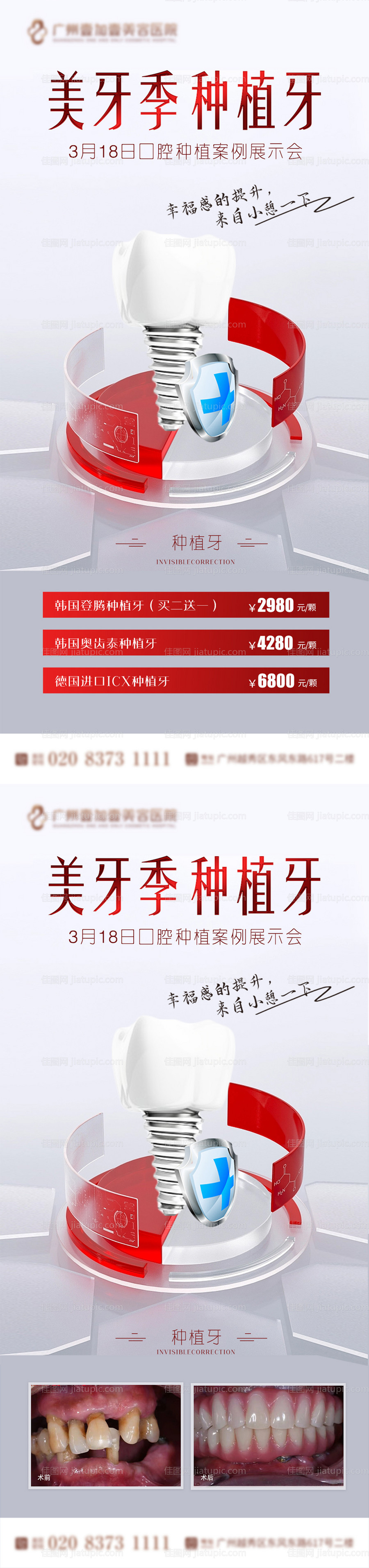 口腔种植牙案例宣传海报-源文件