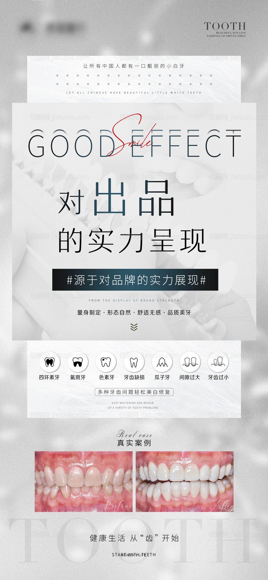 牙科贴面海报-源文件