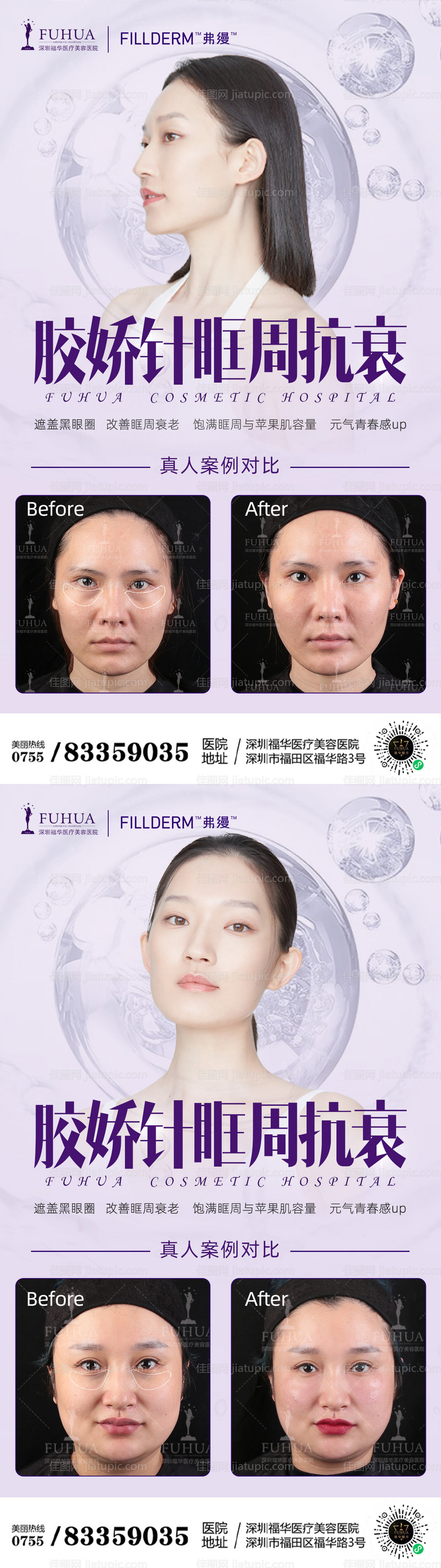 胶娇针眶周抗衰案例对比-源文件