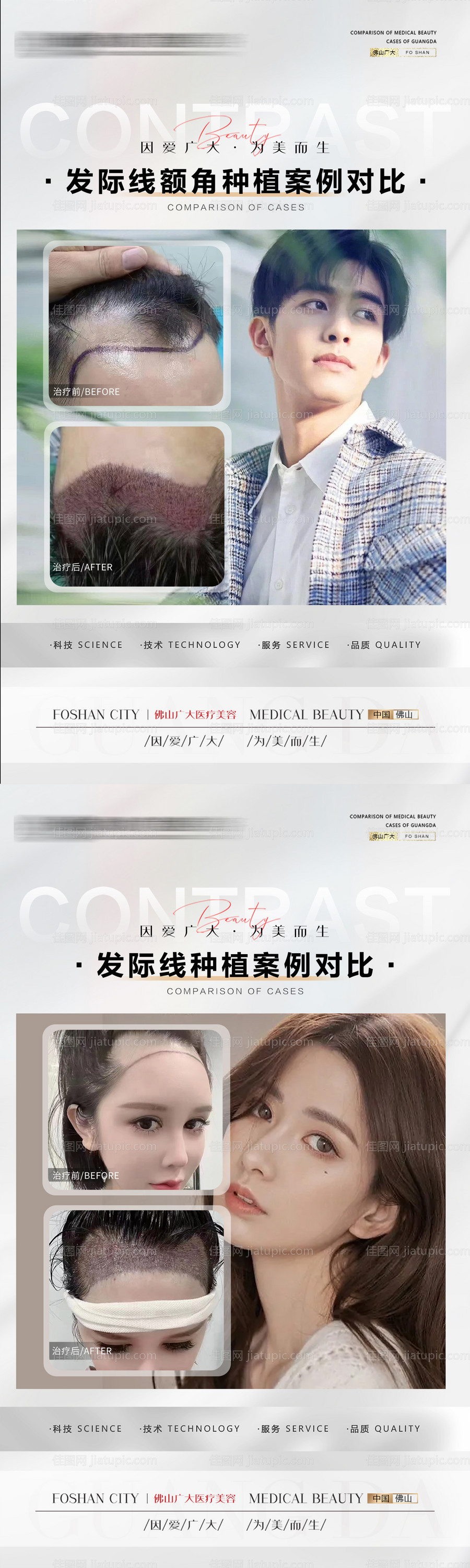 植发案例长图海报-源文件