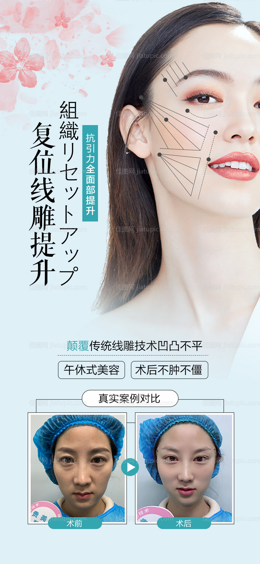 医美整形线雕提升海报-源文件