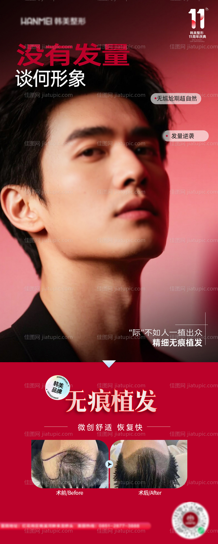 医美植发案例海报-源文件
