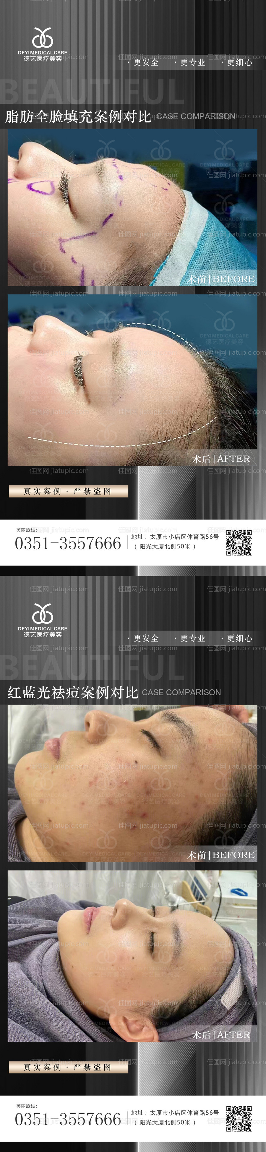 医美案例对比图-源文件