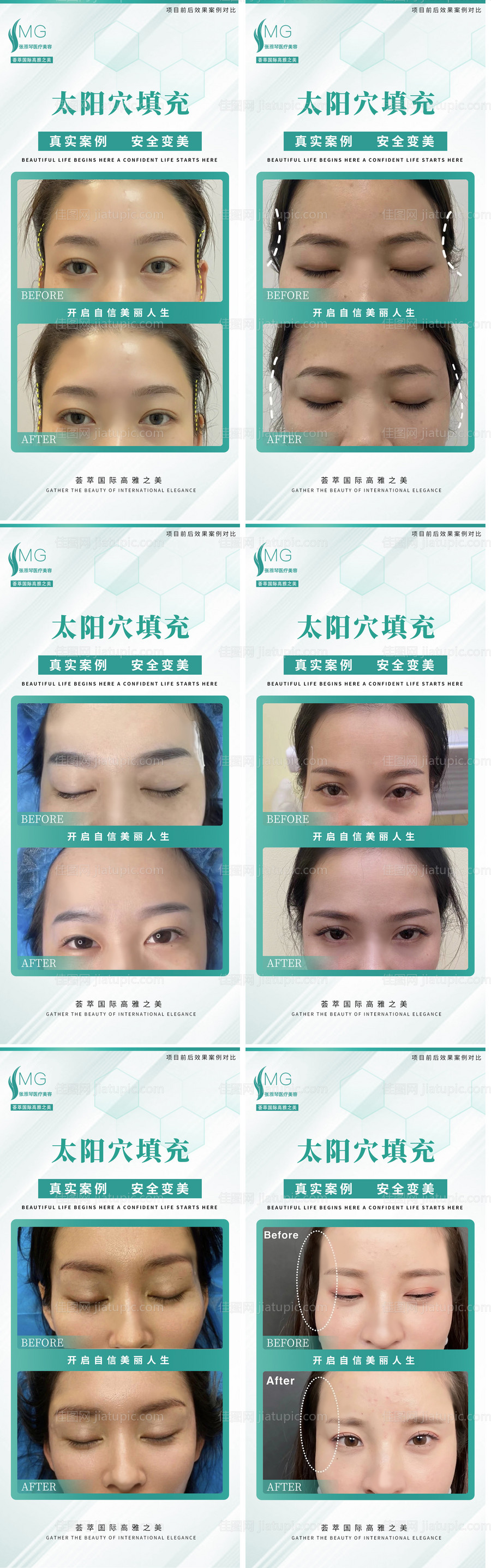 医美填充太阳穴6组案例对比-源文件