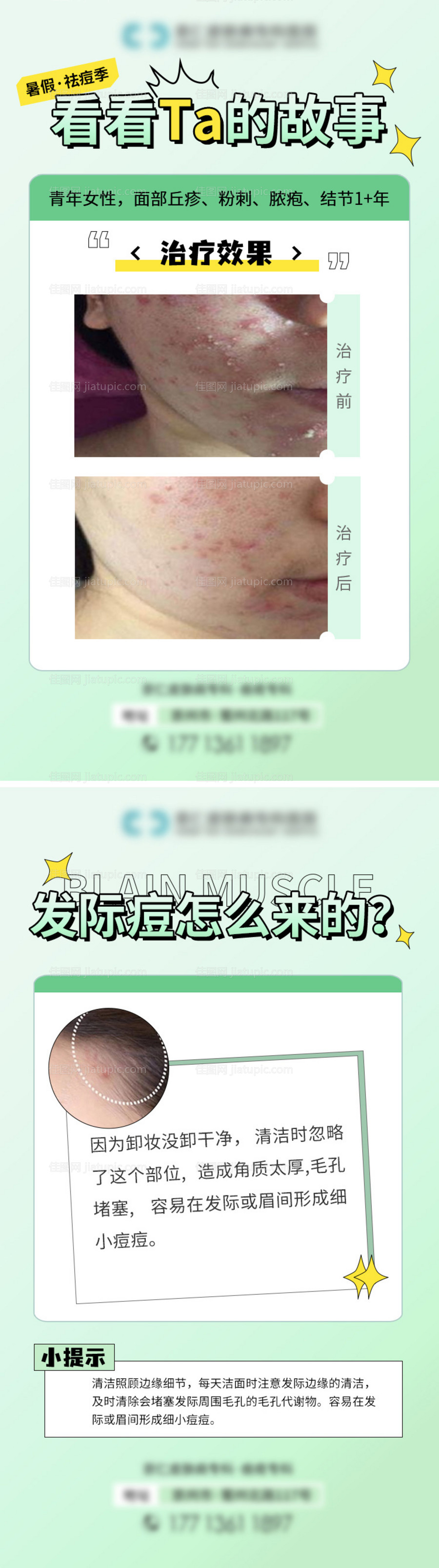 祛痘科普案例海报-源文件