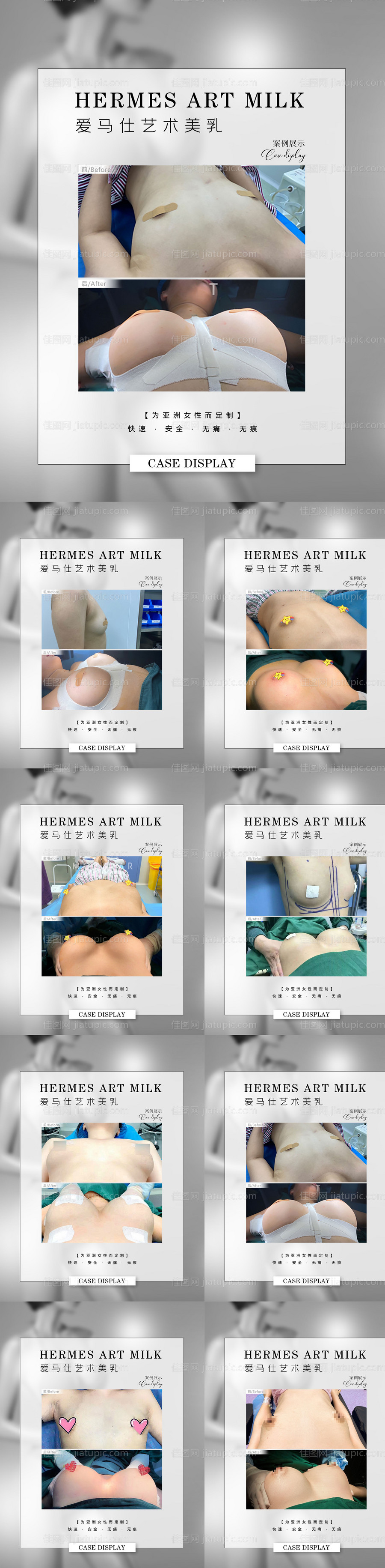 医美隆胸丰胸案例系列-源文件