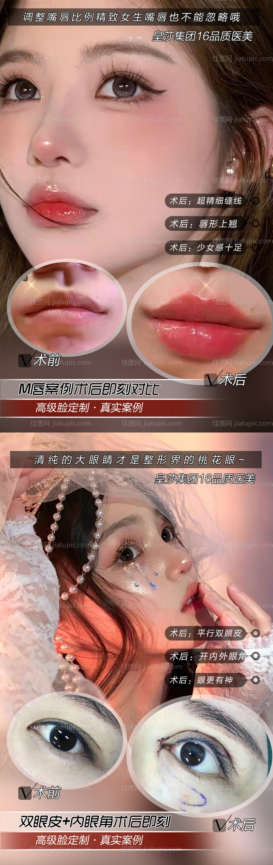 医美开眼角案例宣传海报-源文件