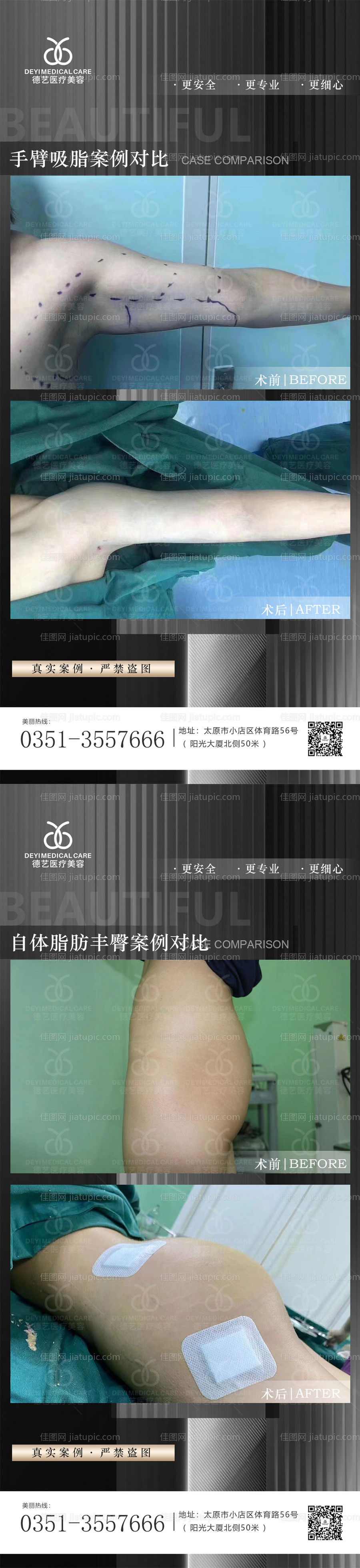 医美案例对比图系列海报-源文件