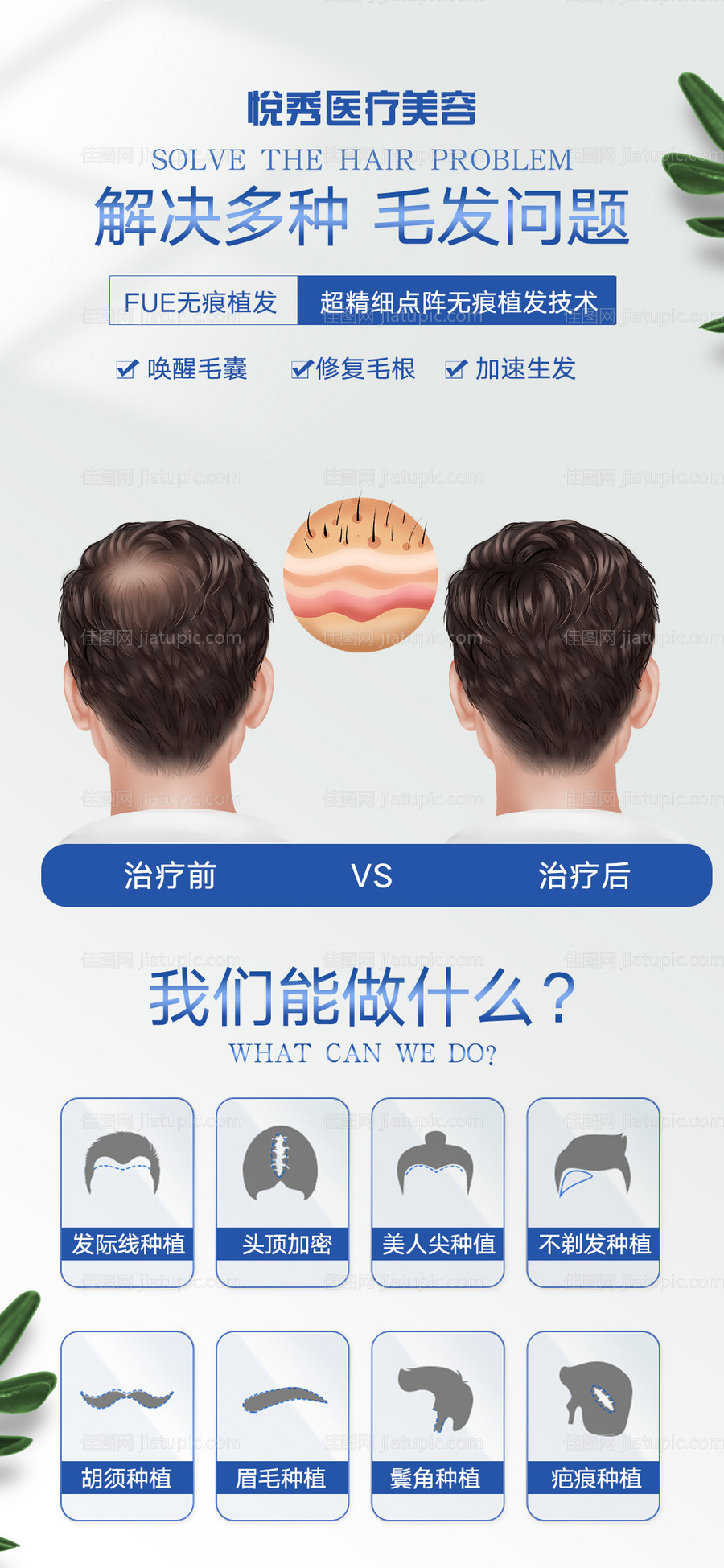 医美植发案例海报-源文件