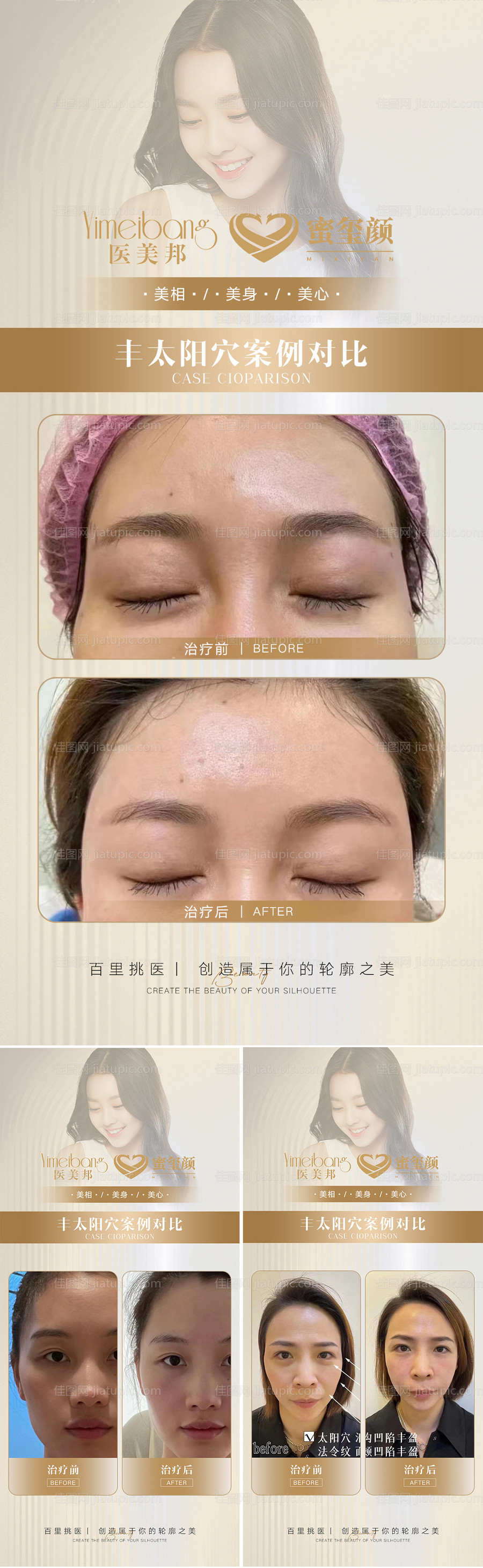 医美丰太阳穴案例对比18组-源文件