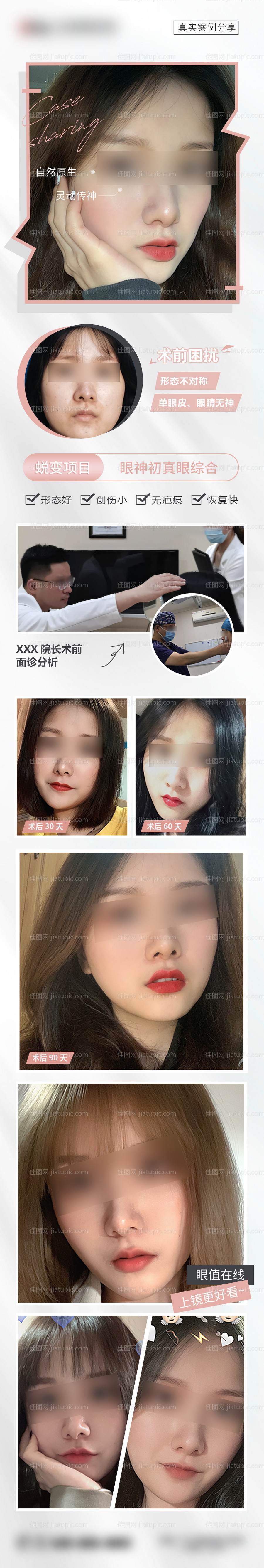 医美双眼皮案例长图-源文件