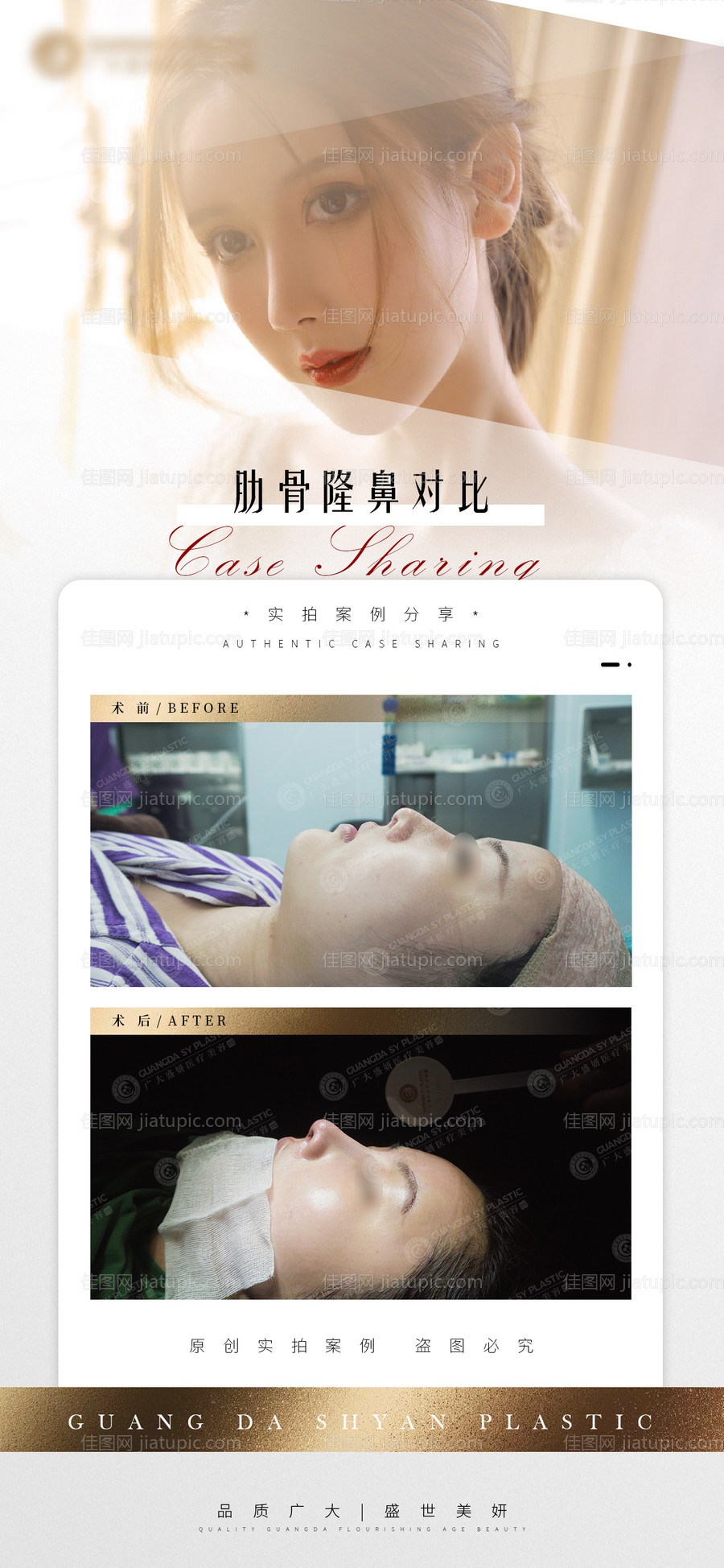 医美隆鼻案例对比图-源文件