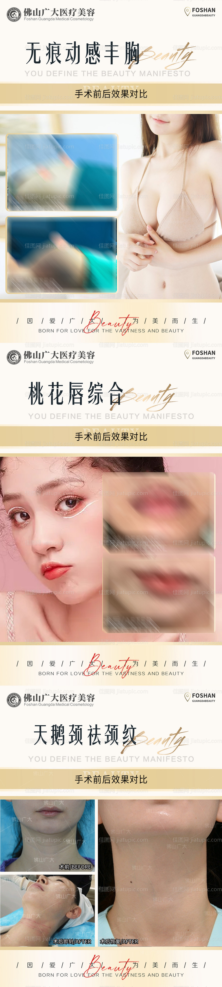 医美丰胸嘴天鹅颈案例系列海报-源文件